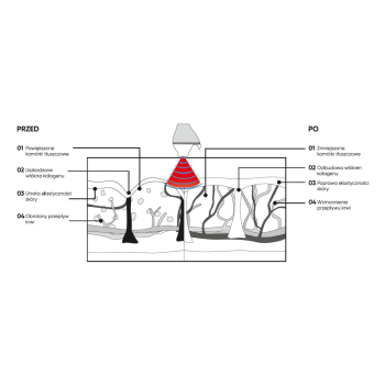 POLDERMA FALA RADIOWA MONOPOLARNA UDERZENOWA    Tanio! SS!